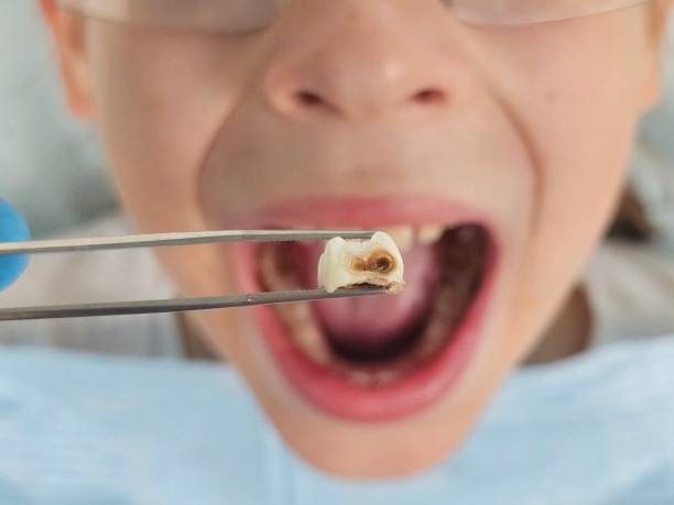 Best Emergency Dentist for Lost Fillings or Crowns in Minor, AL